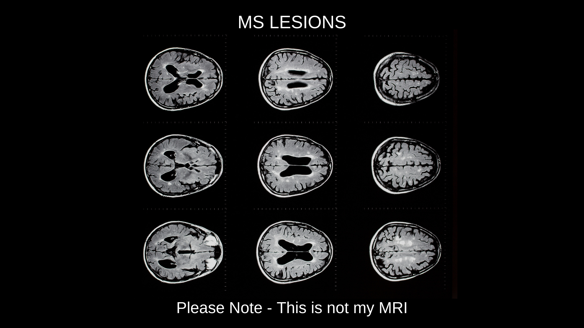 Ms Brain Lesions Mri