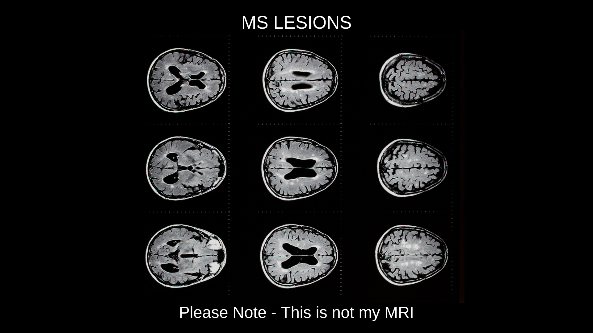 MS Brain Fog